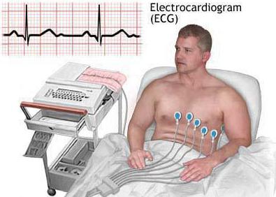 syndrom fredericka na EKG