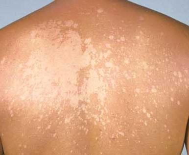 gljivične bolesti kože