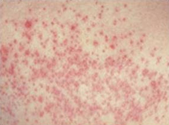 infezione fungina della pelle