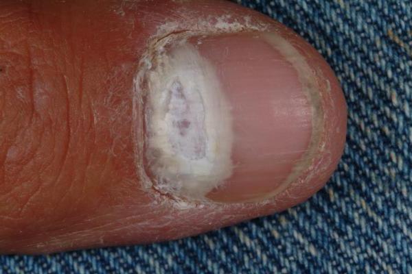 glivične bolezni kože rok