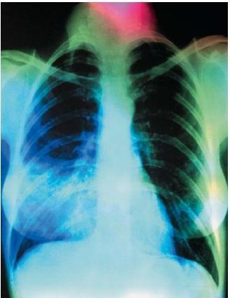 congestione nei polmoni