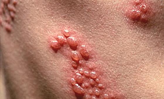 sintomi di herpes genitale