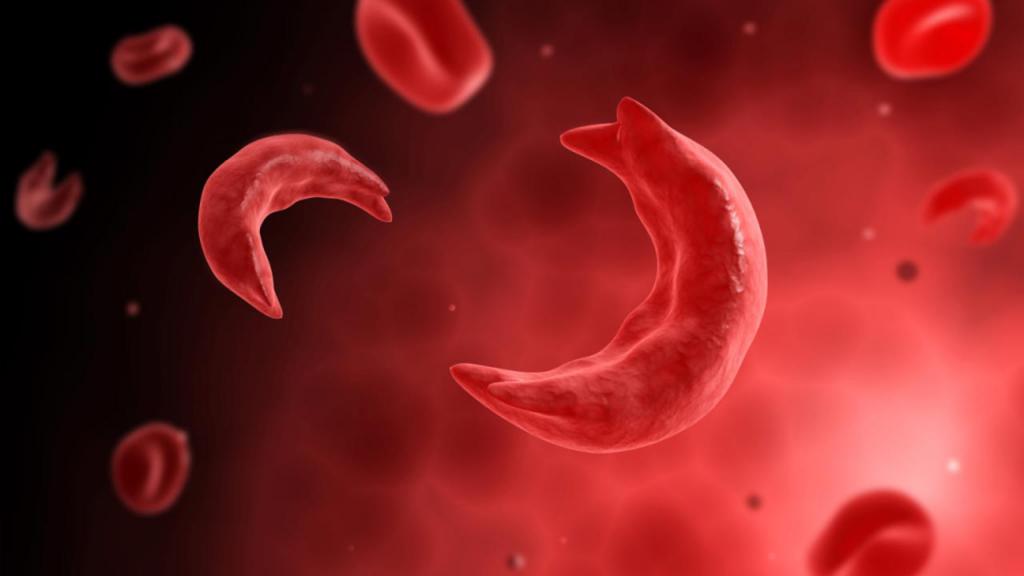 Eritrociti umani nell'anemia falciforme
