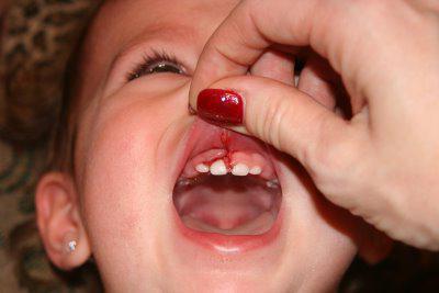 Gingivitis kod djece