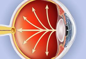 příznaky glaukomu