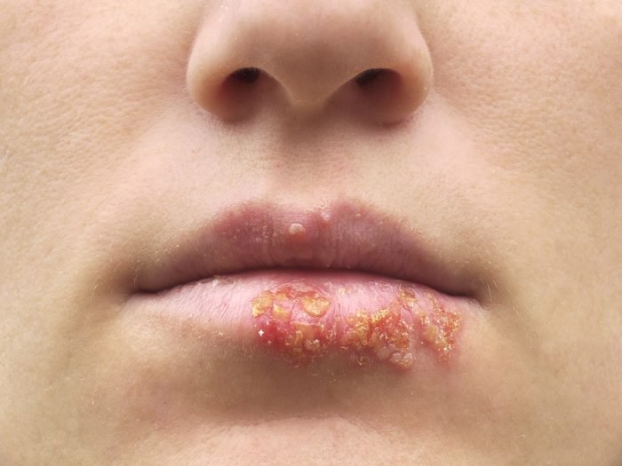herpes na usnama