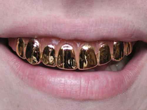 descrizione dei denti d'oro