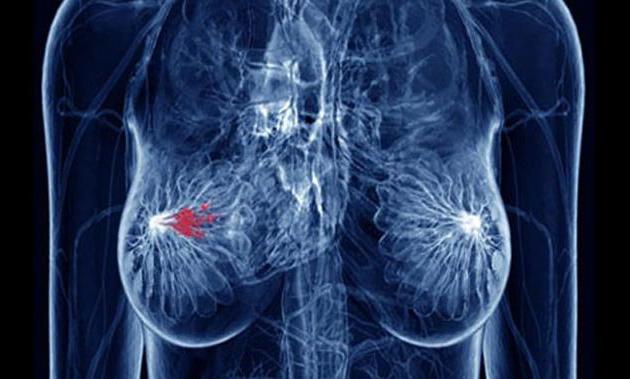 metastázy rakoviny prsu