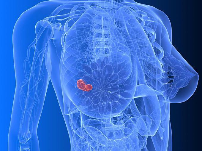 diagnózy rakoviny prsu