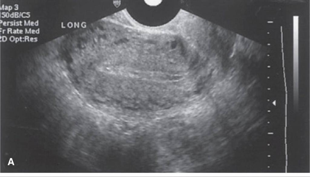 děloha na ultrazvuku