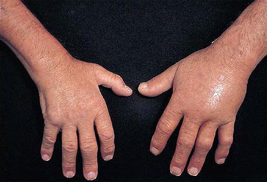 gonfiore delle cause della mano destra