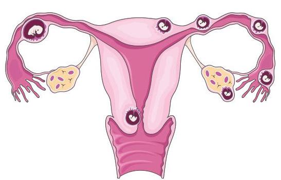 Wskaźniki hgch z ciążą pozamaciczną
