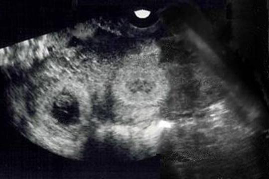 Livello di Hgc nella gravidanza extrauterina