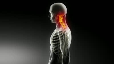 glavobol z osteohondrozo materničnega vratu