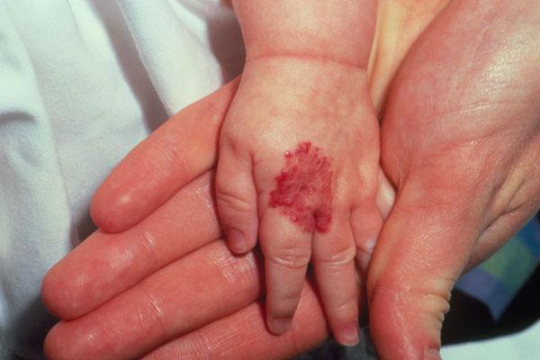 Emangioma nel neonato.  trattamento