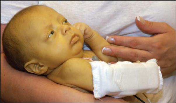 Żółtaczka hemolityczna noworodków