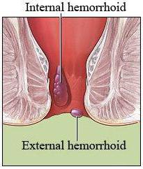 лијечење хемороида након операције