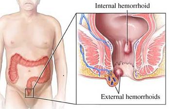 Hemoroidi analni seks