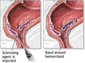 симптоми хемороида код мушкараца