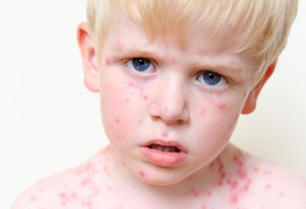 herpesu při léčbě dětí