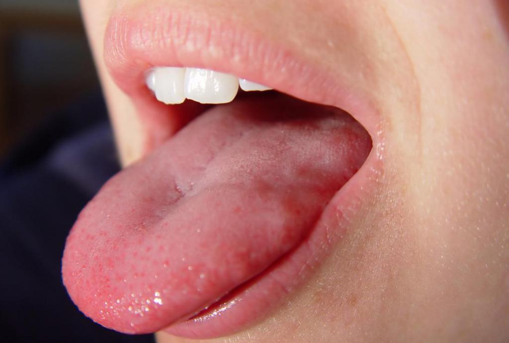 herpes na jeziku pri odraslem