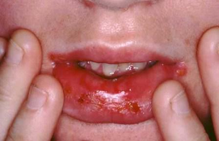herpes in bocca