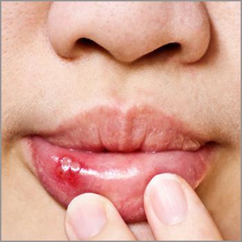 trattamento della bocca dell'herpes