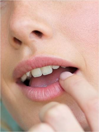 herpes sul trattamento della mucosa orale