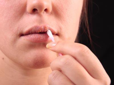 jak léčit herpes v ústech