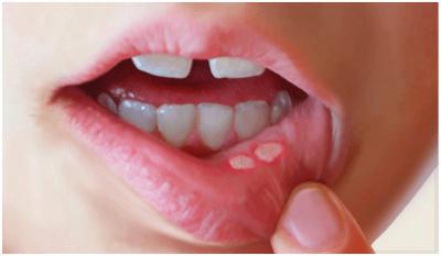 opryszczka w ustach dziecka