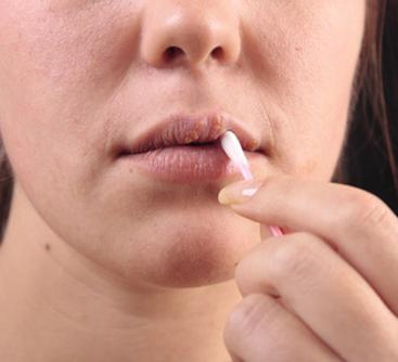 herpes na usnama kako liječiti