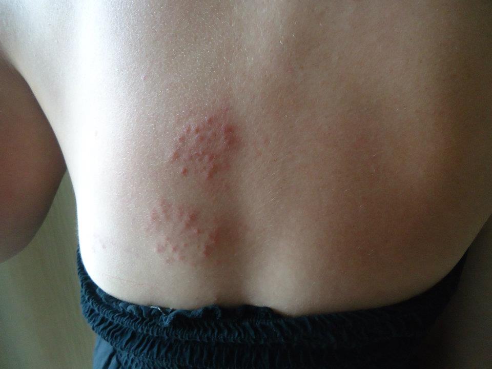 herpes na otrokovem hrbtu