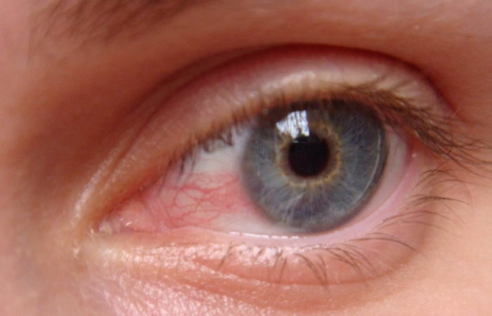 Zrnitost očí s herpes