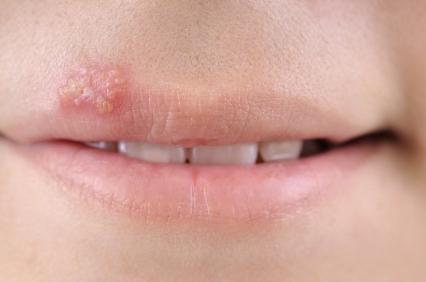 herpes in donne incinte sulle labbra