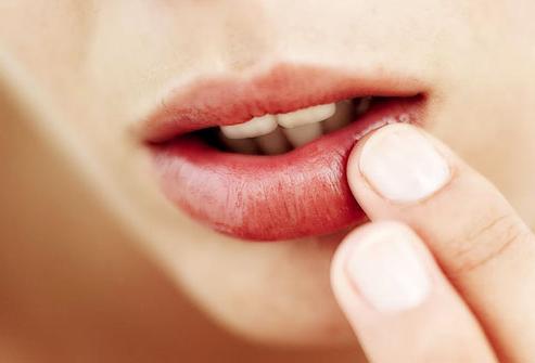 trattamento dell'herpes sulle labbra di rimedi popolari