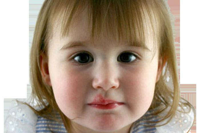 zakaj se herpes pojavi na ustnicah
