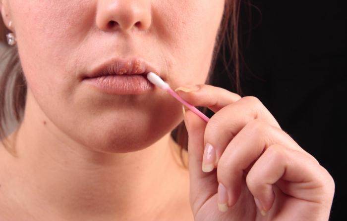 preprečevanje herpesa na ustnicah