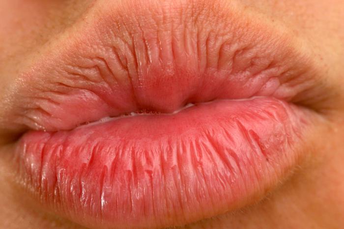 contro l'herpes sulle labbra