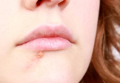 herpes virus na ustnicah