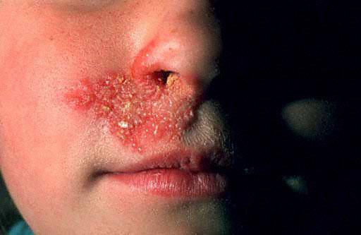 Herpes na tretmanu nosa