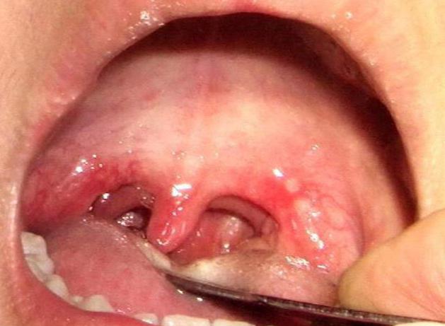 herpes mal di gola in un bambino