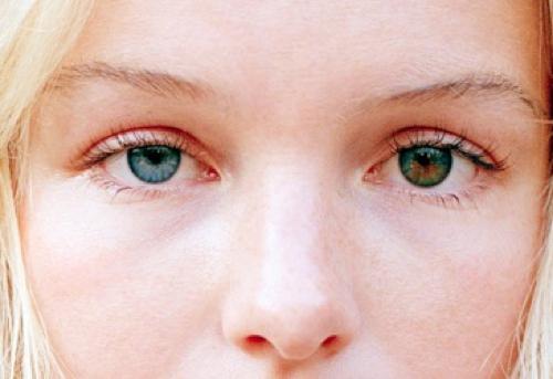 oční heterochromie, jak postupovat