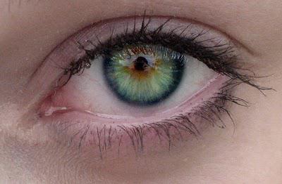 očesna heterochromia pri ljudeh