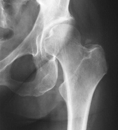 chirurgia della frattura dell'anca