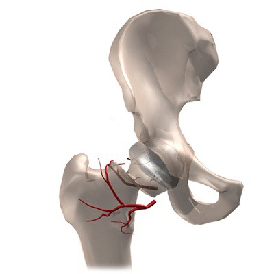 chirurgia sostitutiva dell'anca