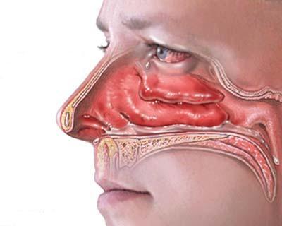 leczenie przewlekłego zapalenia błony śluzowej nosa