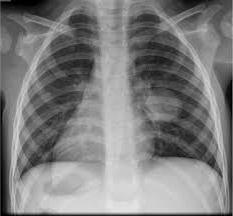 rentgenové vyšetření hrudníku