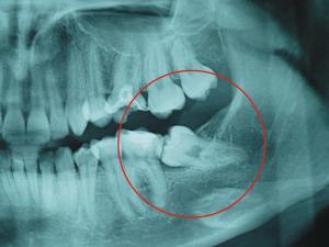 radiografia dei denti