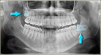 rentgenske slike zob