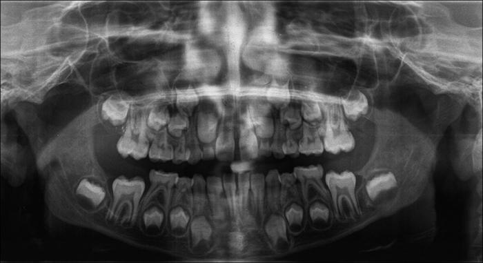 рендгенски приказ млечних зуба